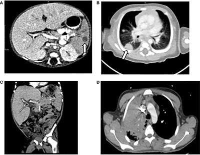 Case Report: Secondary Hemophagocytic Lymphohistiocytosis With Disseminated Infection in Chronic Granulomatous Disease—A Serious Cause of Mortality